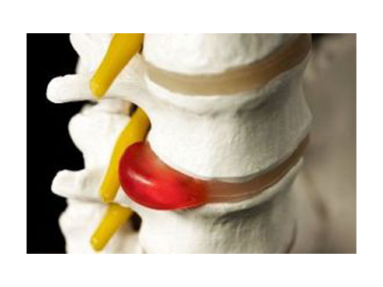 Herniated disc with compression on a nerve (in yellow)